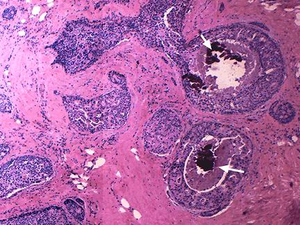 Carcinoma microinfiltrante - <div style=